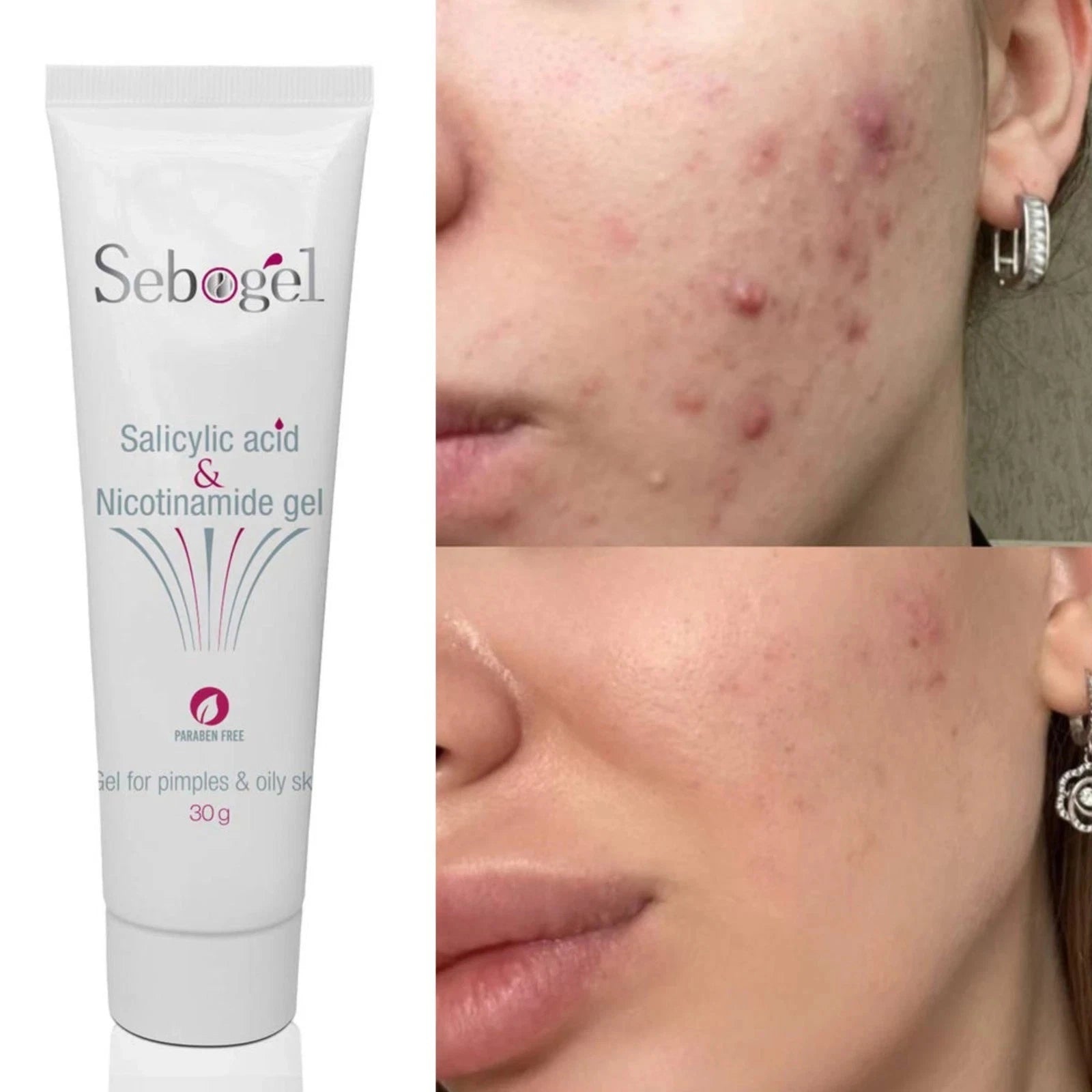 Sebogel Salicylic Acid & Nicotinamide Gel for Pimples and Oily Skin, 30gm