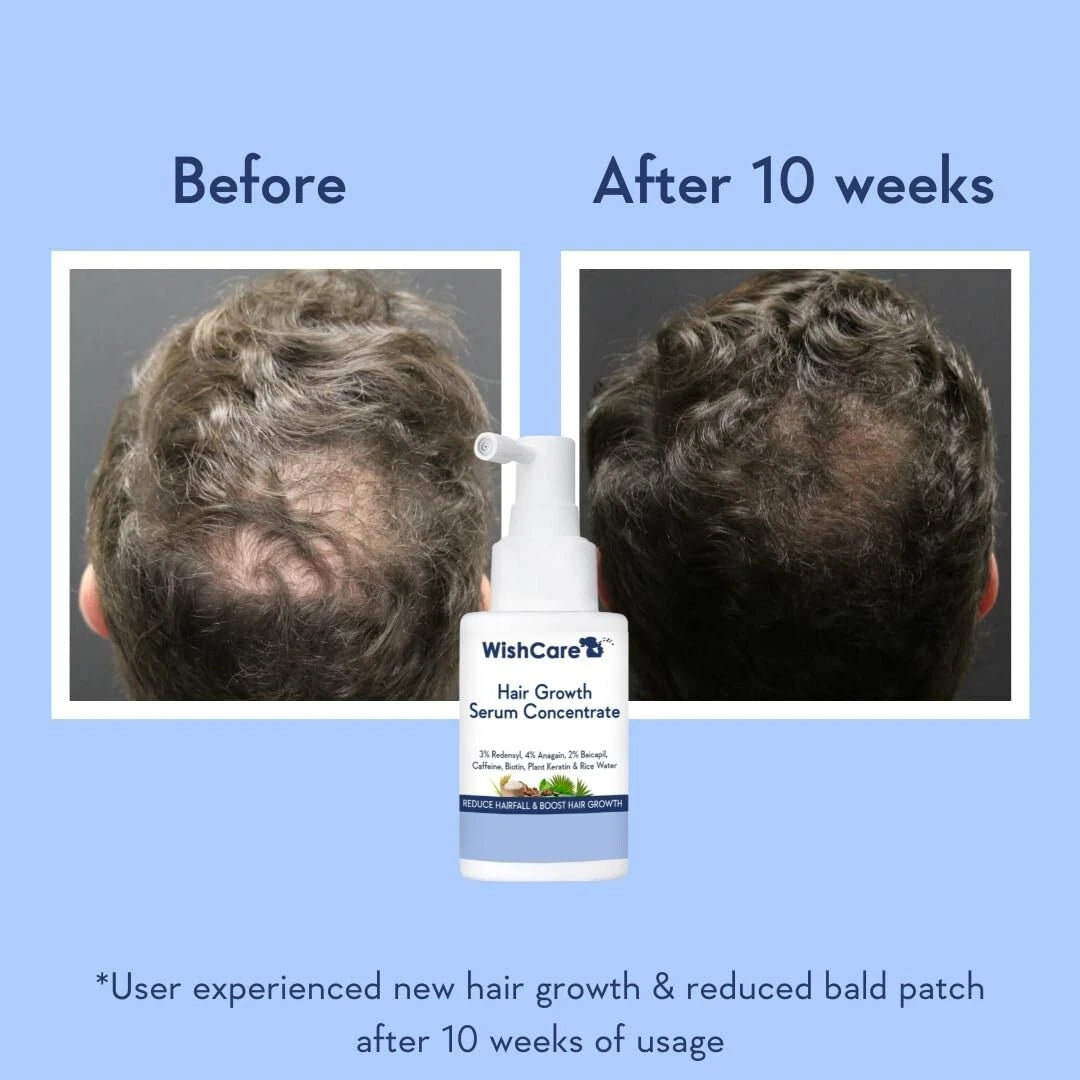 Share WishCare Hair Growth Serum Concentrate with Plant Keratin & Rice Water etc. 30ml