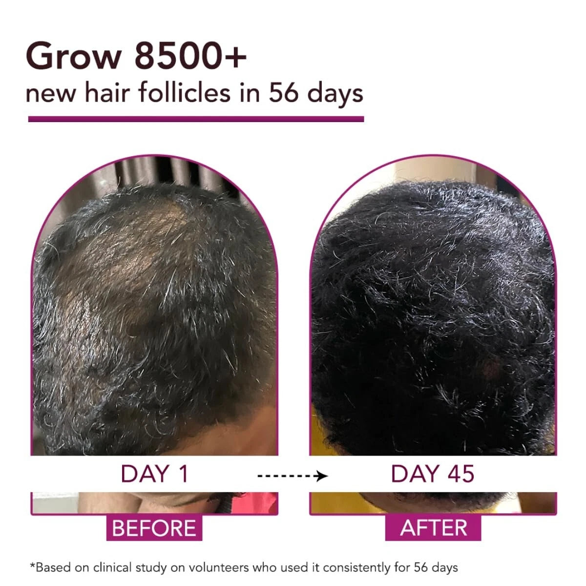 Glenmark Bontress Pro+ Scalp Serum - 60 ml